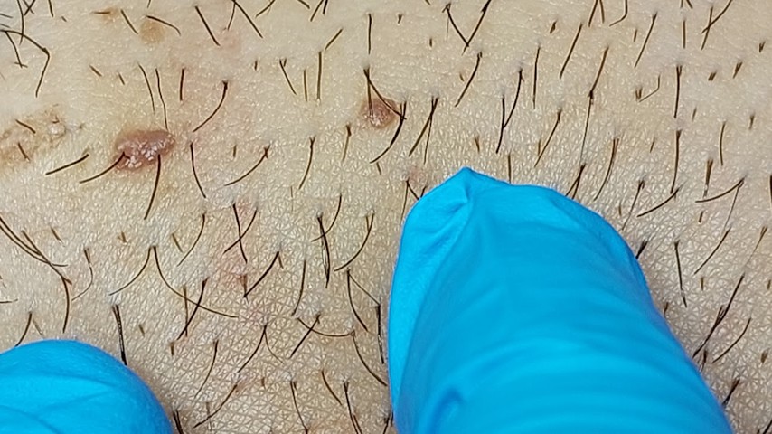 genital sigil hpv youtube playlist