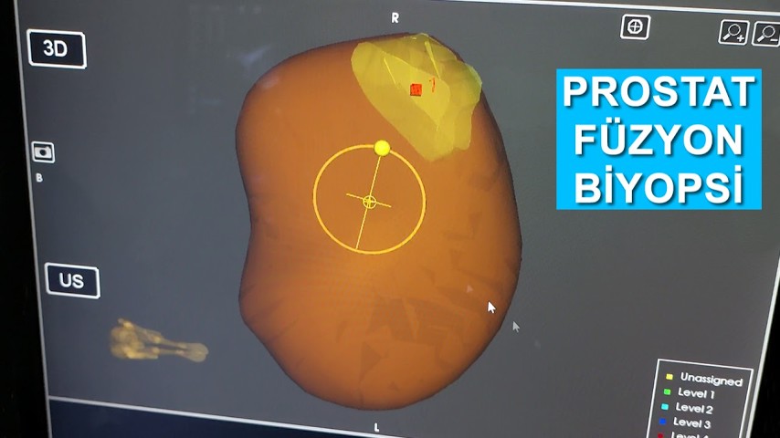 prostat biyopsi youtube playlist